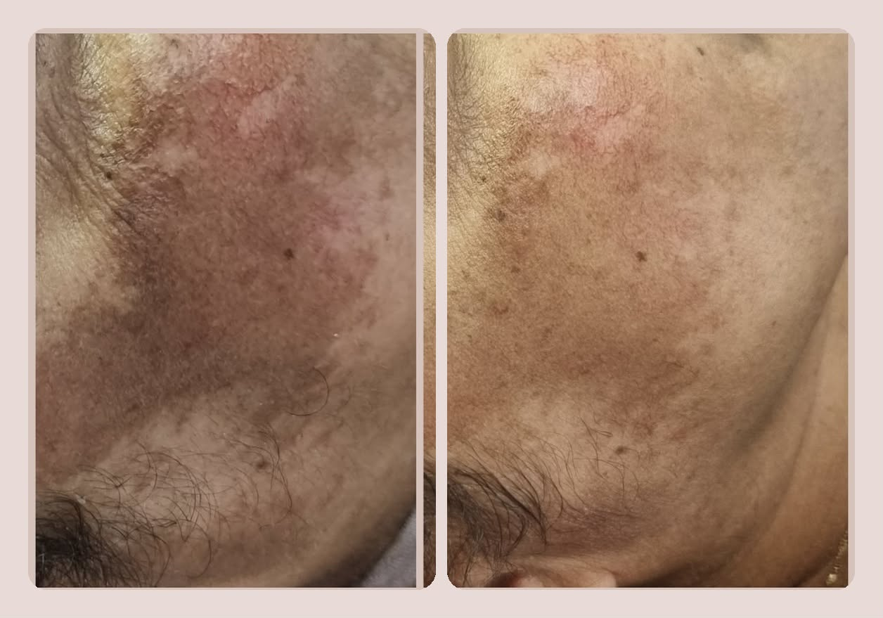 Tratamento de Melasma