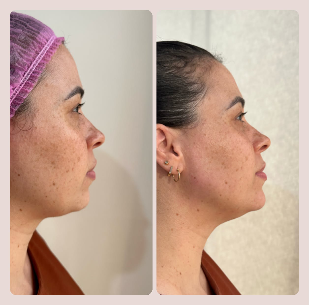Perfiloplastia